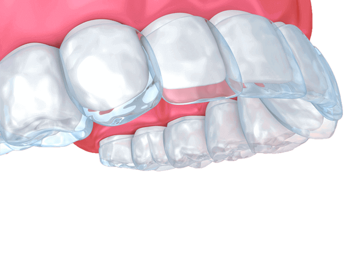 teeth whitening in lahore